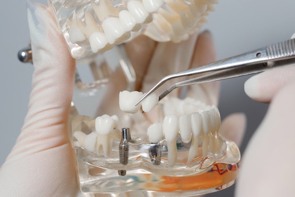 How Dental Implants Improve Oral Health And Function